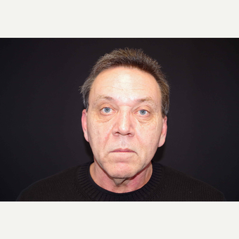 55-64 year old man treated with Direct Neck Lift before 3439245