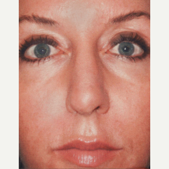 Rhinoplasty after 3814315