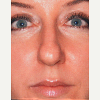 Rhinoplasty before 3814315