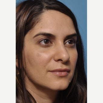 Finesse rhinoplasty without any external incisions - subtle changes can make a difference after 1747265