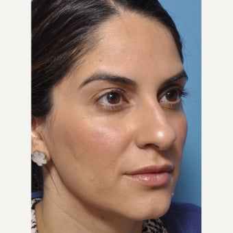 Finesse rhinoplasty without any external incisions - subtle changes can make a difference before 1747265