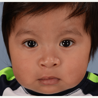 17 or under year old man treated with Cleft Lip And Palate Repair after 3639074