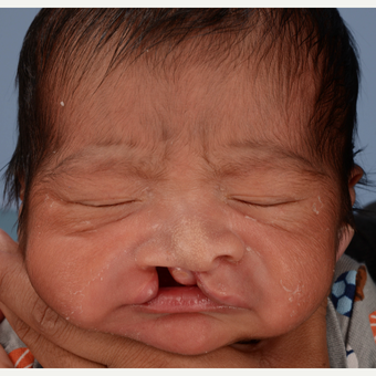 17 or under year old man treated with Cleft Lip And Palate Repair before 3639074
