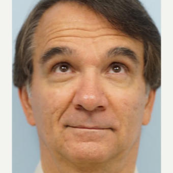 55-64 year old man treated with Restylane Silk before 3710912