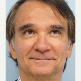 55-64 year old man treated with Restylane Silk after 3710912