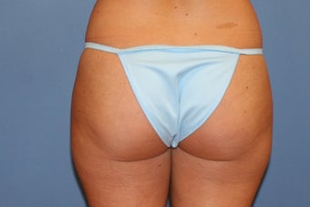 Smartlipo before 91278