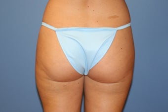 Smartlipo after 91278