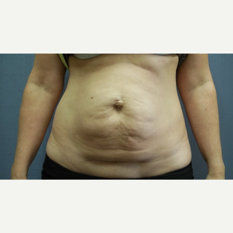 35-44 year old woman treated with Tummy Tuck before 3108255