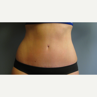 35-44 year old woman treated with Tummy Tuck after 3108255