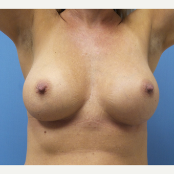 35-44 year old woman treated with Breast Augmentation after 3685243