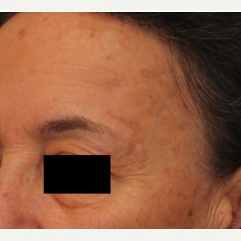 Complex Mohs Repair of the Forehead after 2553544