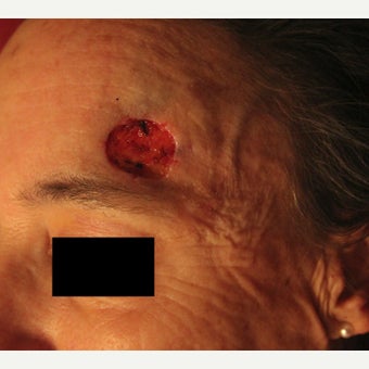 Complex Mohs Repair of the Forehead before 2553544