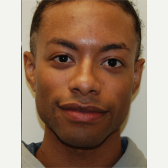 25-34 year old man treated with Silikon 1000 for permanent cheek augmentation after 3487854