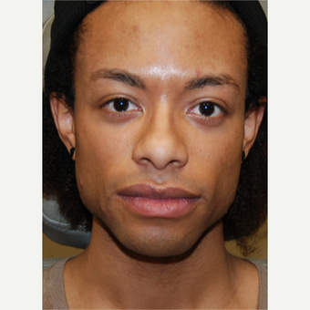 25-34 year old man treated with Silikon 1000 for permanent cheek augmentation before 3487854