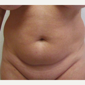 Abdominal Liposuction for this 46 Year Old Woman before 3025358