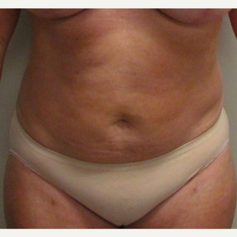 Abdominal Liposuction for this 46 Year Old Woman after 3025358