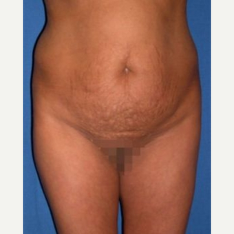 35-44 year old woman treated with Tummy Tuck before 3009735