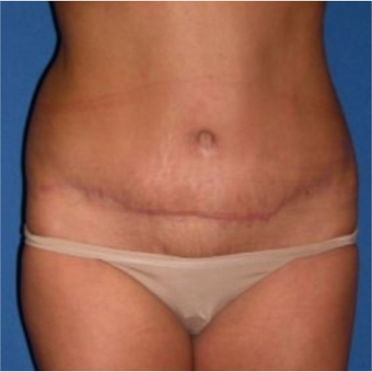 35-44 year old woman treated with Tummy Tuck after 3009735