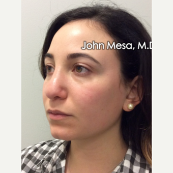 25-34 year old woman treated with Buccal Fat Removal before 3769127