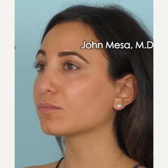 25-34 year old woman treated with Buccal Fat Removal after 3769127