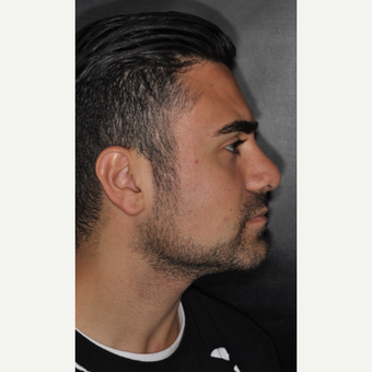 18-24 year old man treated with Rhinoplasty 6 weeks post-op after 3500129