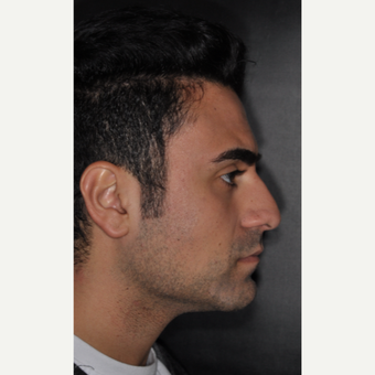 18-24 year old man treated with Rhinoplasty 6 weeks post-op before 3500129
