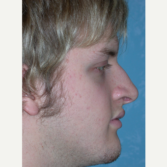 18-24 year old man treated with Rhinoplasty before 3732511