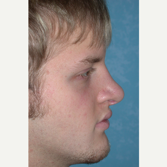 18-24 year old man treated with Rhinoplasty after 3732511