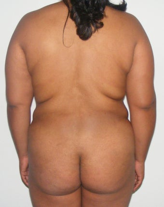 28 years old female treated for lipodistrofy on her back ( fat exces on her back) before 983116
