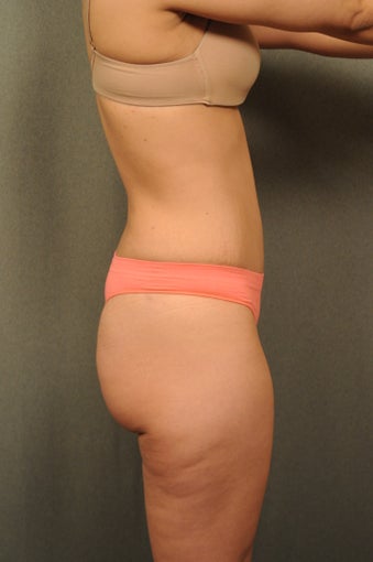 33 year old female desiring a flatter stomach 951077