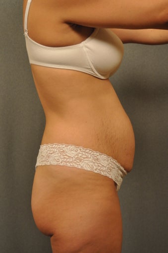 33 year old female desiring a flatter stomach 951077