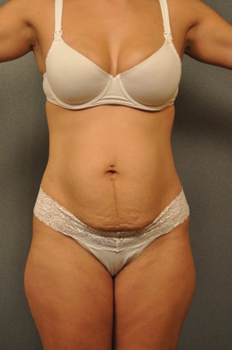 33 year old female desiring a flatter stomach before 951077