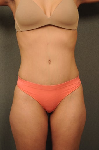 33 year old female desiring a flatter stomach after 951077