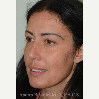 39 year old woman treated with Rhinoplasty after 3460898