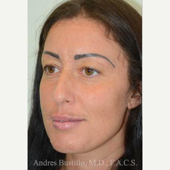 39 year old woman treated with Rhinoplasty before 3460898