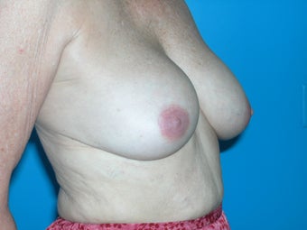 59 yr old woman with breast lift 1098257