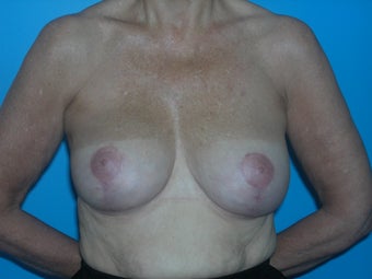 59 yr old woman with breast lift after 1098257