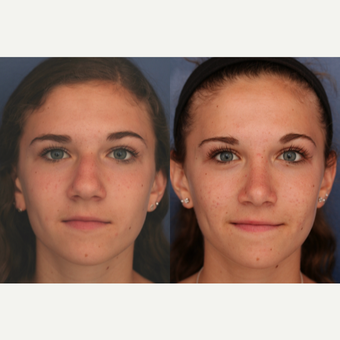 25-34 year old woman treated with Rhinoplasty after 3698927
