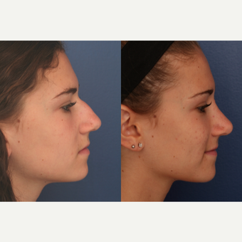 25-34 year old woman treated with Rhinoplasty before 3698927