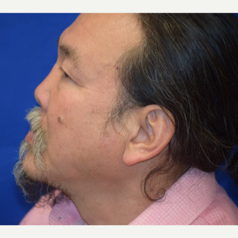 55-64 year old man treated with Rhinoplasty after 3741622