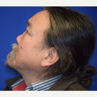 55-64 year old man treated with Rhinoplasty before 3741622