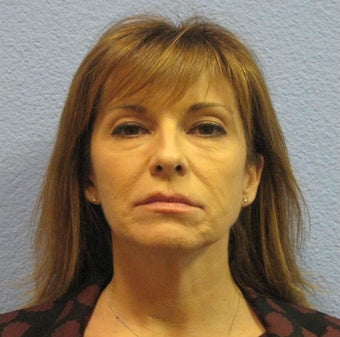 Ultherapy after 1156464