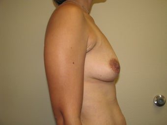 35 year old female with 450 cc saline implants 1047121