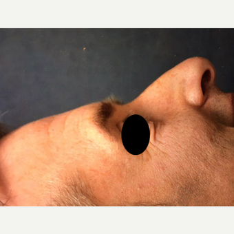 35-44 year old man treated with Rhinoplasty before 3211859