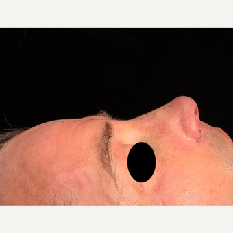 35-44 year old man treated with Rhinoplasty after 3211859