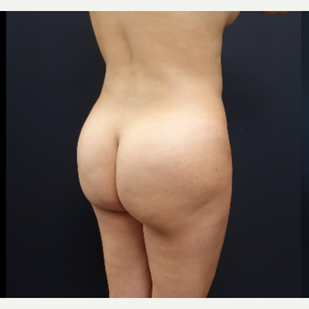 25-34 year old woman treated with Brazilian Butt Lift Revision before 3286170