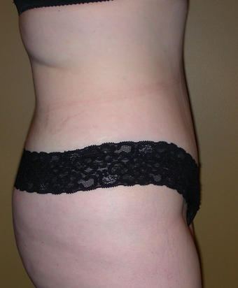 abdominoplasty after 237385