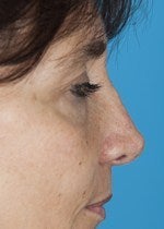 46 yo female treated for alar retraction, saddle nose deformity, and assymetric nasal tip after 1484305
