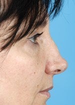46 yo female treated for alar retraction, saddle nose deformity, and assymetric nasal tip before 1484305