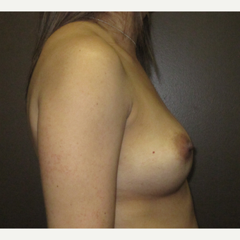 35-44 year old woman treated with Breast Implants before 3424524